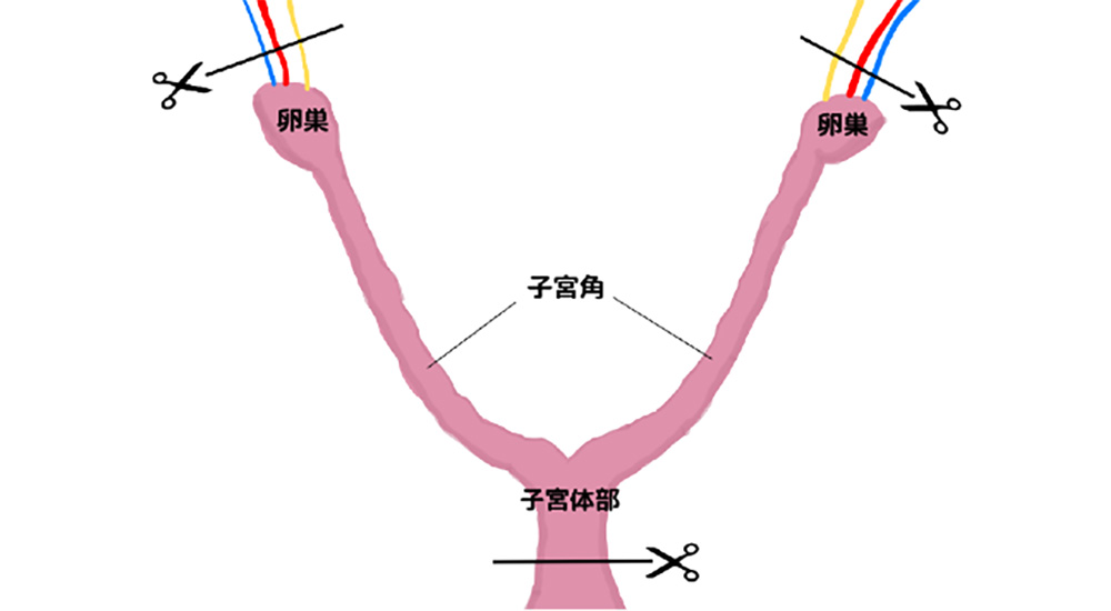 子宮摘出術の準備方法